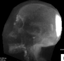 MRI image of the skull showing pooled resin at the back