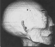 CT image of the mummy's head