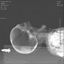 Soap Lady's Cranial Radiography