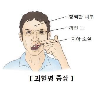괴혈병.png