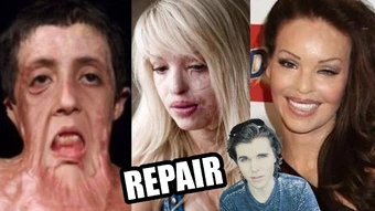 Amazing Facial Reconstructions Plastic Surgery Done Right Onision Wiki Fandom Video highlights how the tip was refined in order to rotate and decrease tip projection. amazing facial reconstructions plastic