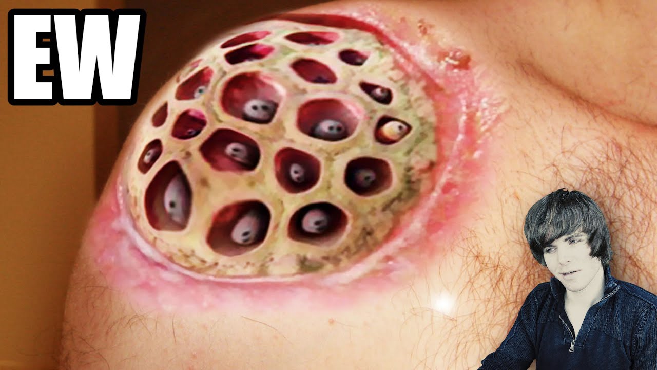 Photos That Trigger Trypophobia Fear Of Holes Onision Wiki Fandom