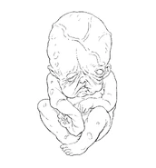 Terceira lineart de feto infectado com o Infecticídio