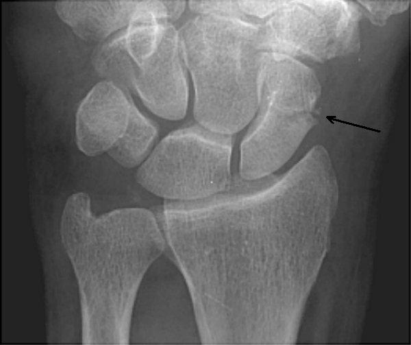 carpal bone fracture