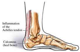 Inflammation of the Achilles tendon