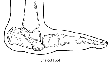 Pronation of the foot - Wikipedia
