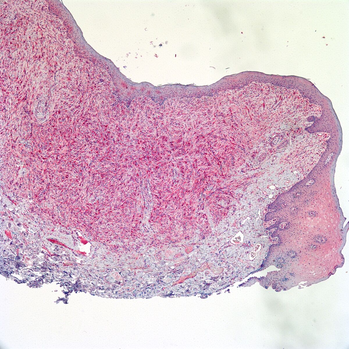 Factor XIIIa Factor 13a Pathology Resident Wiki Fandom Factor XIIIa Factor 13a Pathology Resident Wiki Fandom