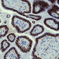 PAX-8 expression in serous ovarian carcinoma.