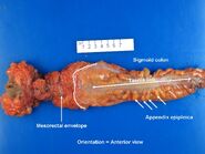 Rectum anterior view