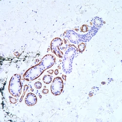 Muscle Specific Actin Msa Pathology Resident Wiki Fandom