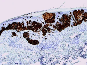 MelanA (A103) highlighting invasion in melanoma