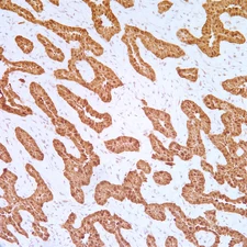 Calretinin expression in mesothelioma.
