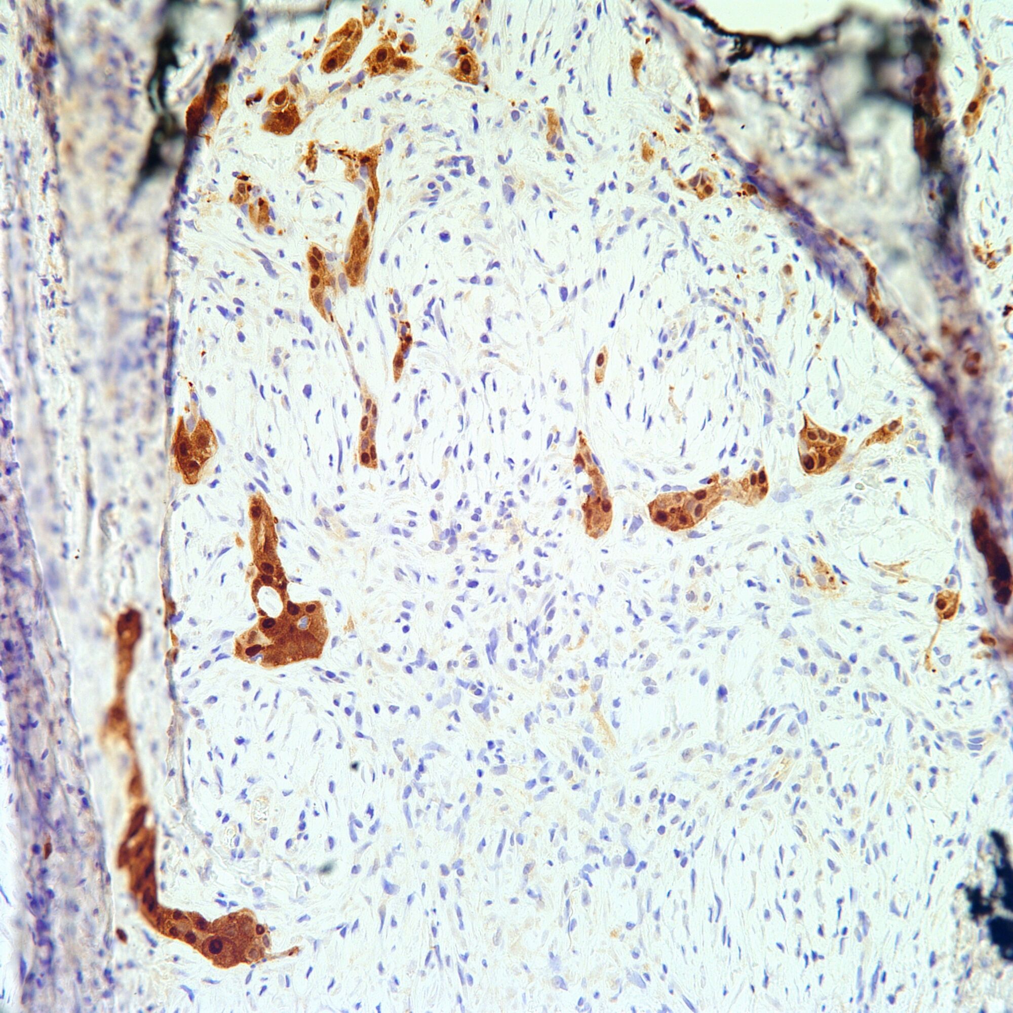 nccn guidelines insights malignant pleural mesothelioma