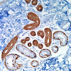 Cytokeratin 5 6 Ck 5 6 Pathology Resident Wiki Fandom