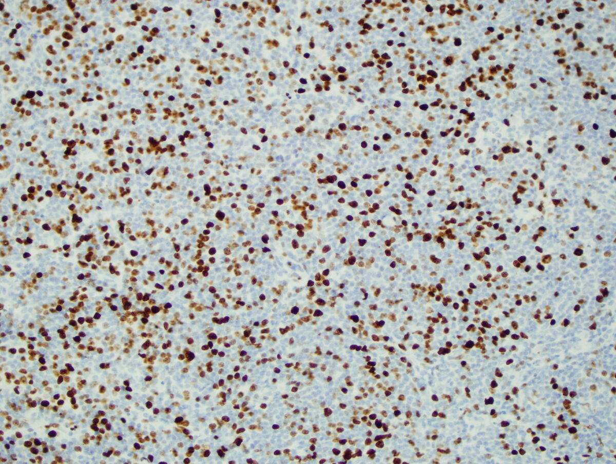 Ki 67 MIB 1 Pathology Resident Wiki Fandom Ki 67 MIB 1 Pathology Resident Wiki Fandom