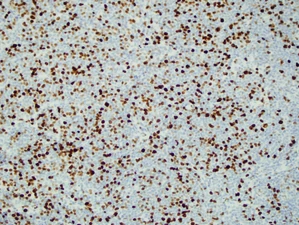 MIB1 (Ki-67) shows proliferating cells-mantle cell