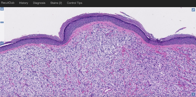 Cutaneous PEComa