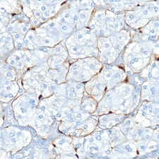S100 staining sustentacular cells in paraganglioma
