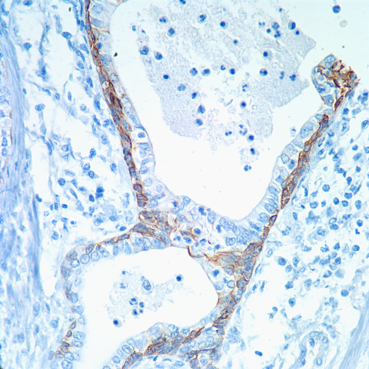 Cytokeratin 5 6 Ck 5 6 Pathology Resident Wiki Fandom