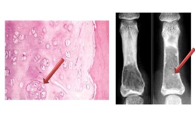 Fibroma, Patología clínica Wiki