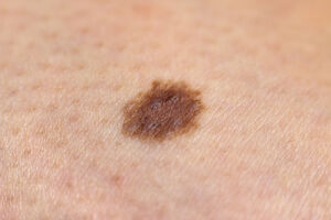 Skin mole.jpg