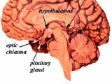 Decalcify Pineal gland