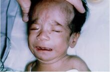 severe fetal alcohol syndrome