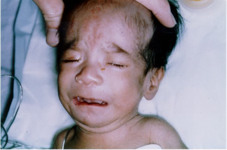 palpebral fissure fetal alcohol syndrome