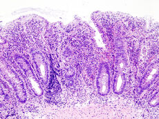 Ulcerative colitis (2) endoscopic biopsy