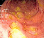 CD colitis