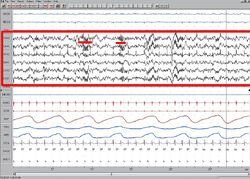 Stage 2 Sleep. EEG highlighted by red box. Sleep spindles highlighted by red line.