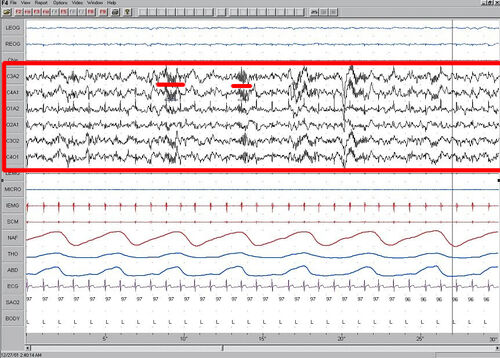 Stage 2 Sleep. EEG highlighted by red box. Sleep spindles highlighted by red line.