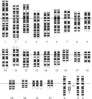 Down Syndrome Karyotype