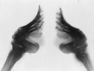 Bound feet (X-ray)