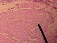 Cross sectional cut of vocalis muscle