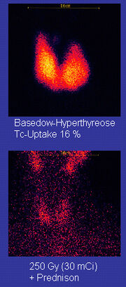 Basedow-vor-nach-RIT