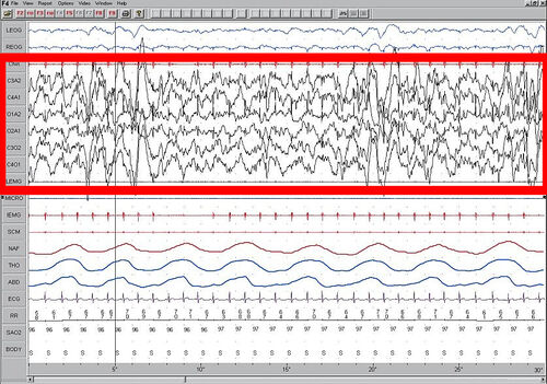 Stage 4 Sleep. EEG highlighted by red box.
