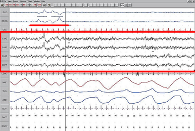 Polysomnography - Wikipedia