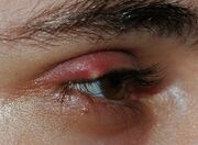 Stye02