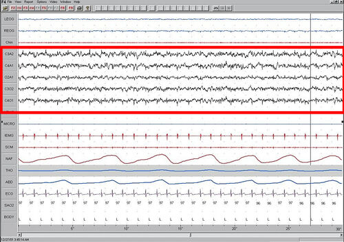 Stage1 Sleep. EEG highlighted by red box.