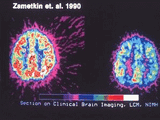 Controversy about ADHD