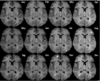 Monthly multiple sclerosis MRI