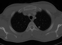 Chest CT scan with lung metastatis 2