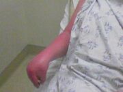 Severe CRPS