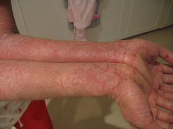 Eczema Psychology Wiki Fandom