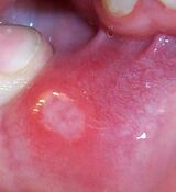 Canker sore