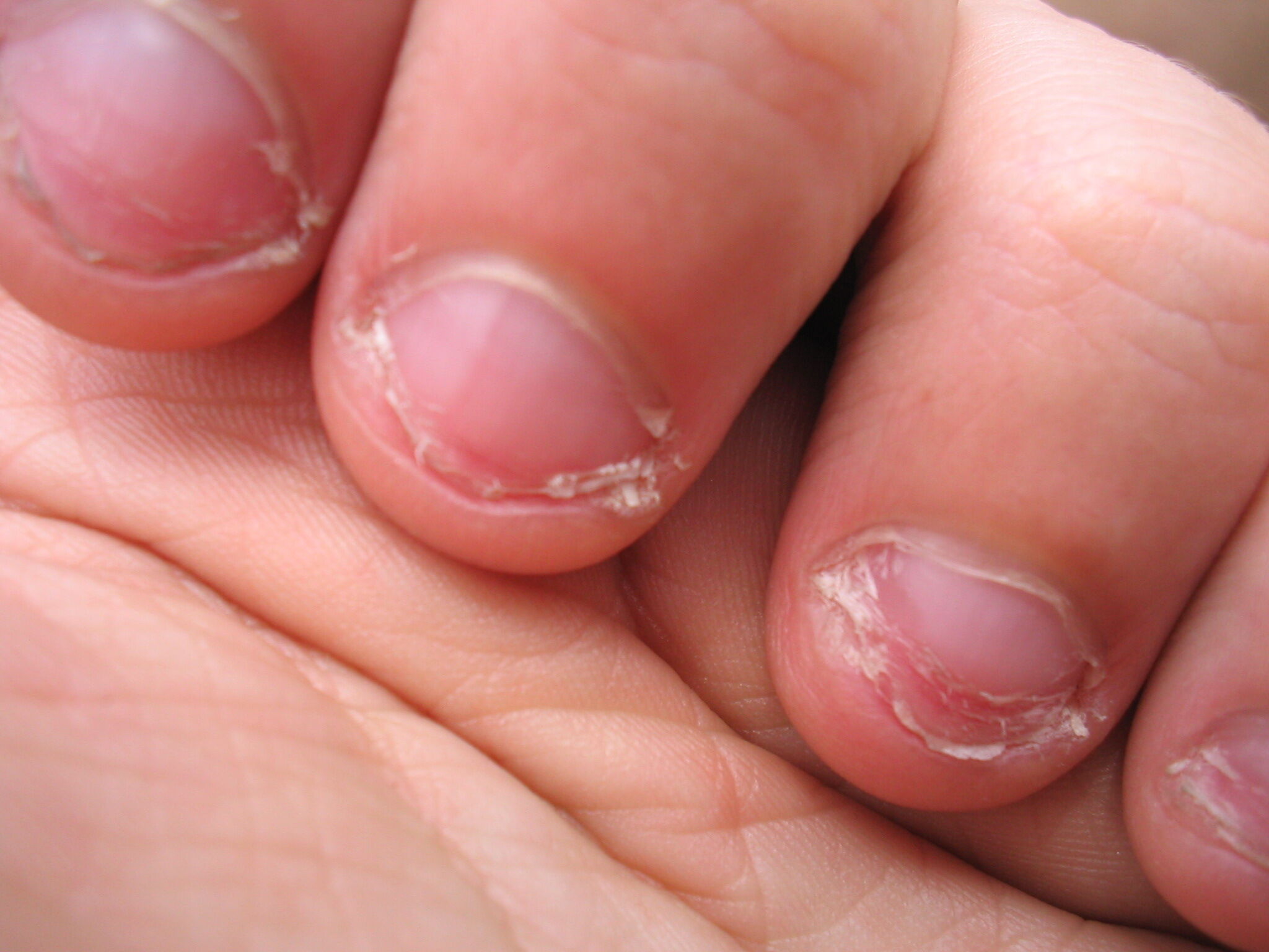 Bitten nails deals