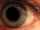 Pupil dilation
