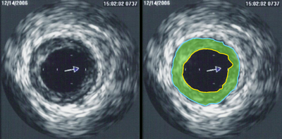 IVUS of CAD