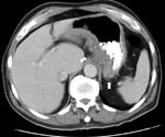 CT scan gastric CD